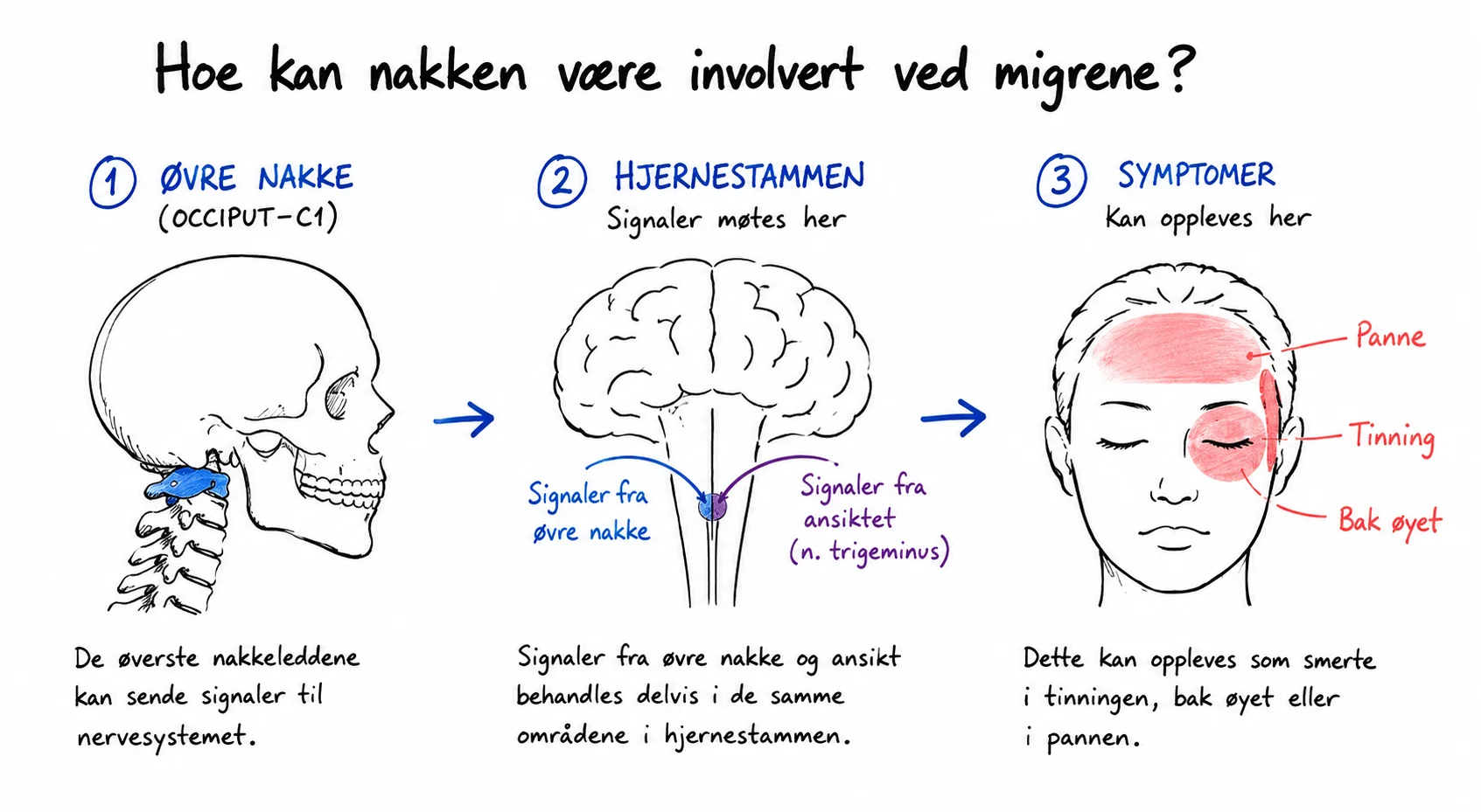 Hvordan øvre nakke kan påvirke områder i nervesystemet som også er involvert ved migrene.